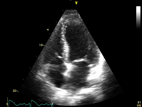 Advanced Heart Failure Treatment - Apex Heart Clinic